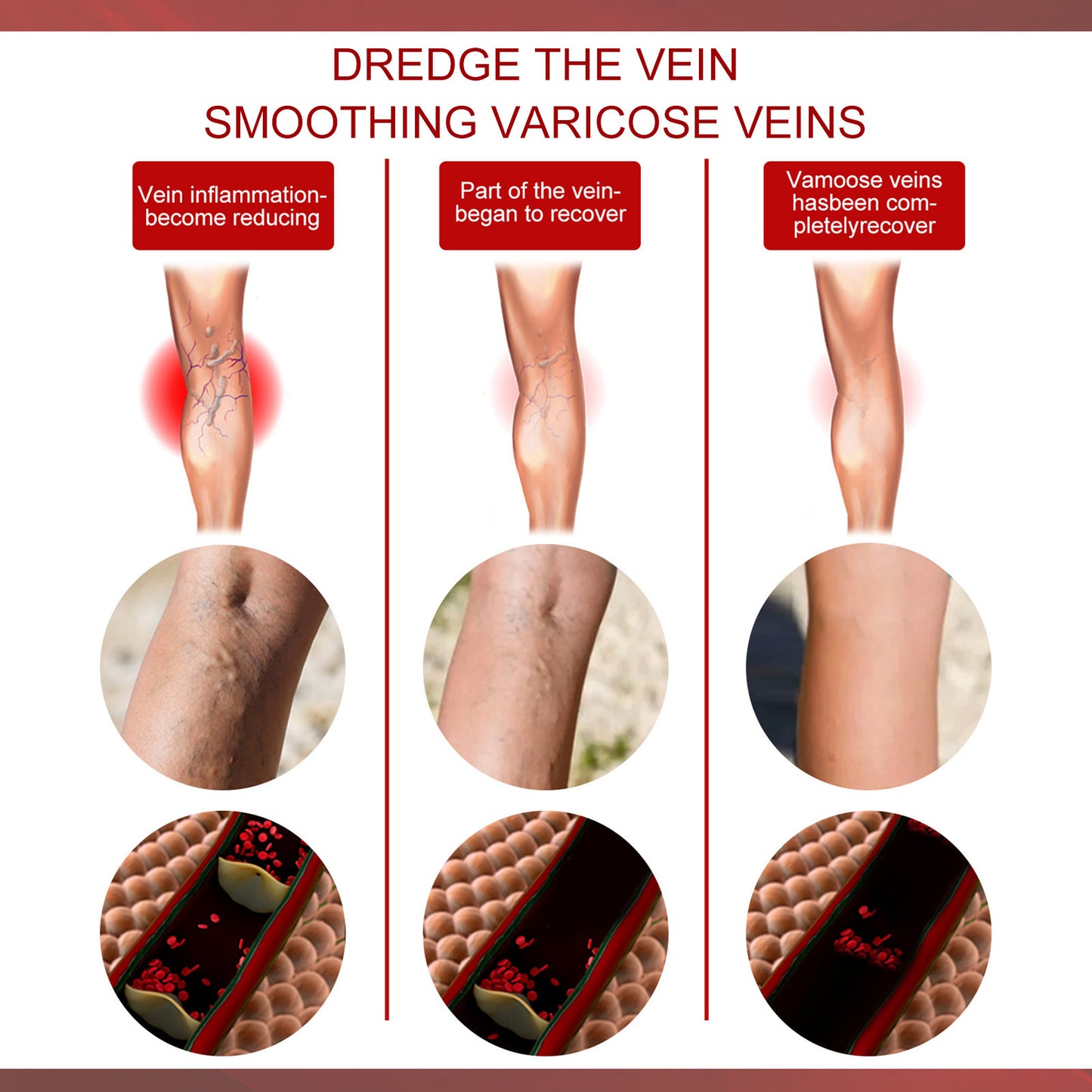 Varicose Vein Patch for Legs