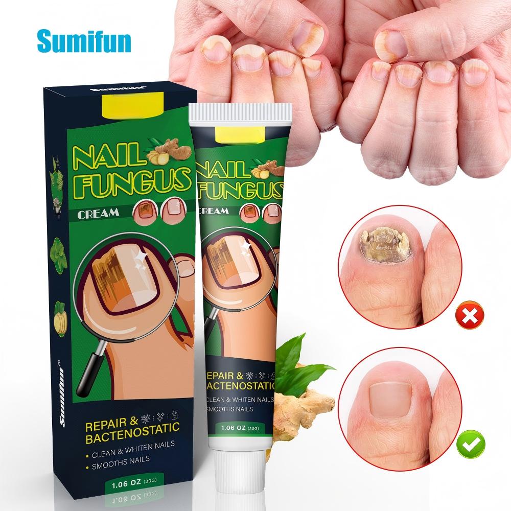 Nail Fungus Cream