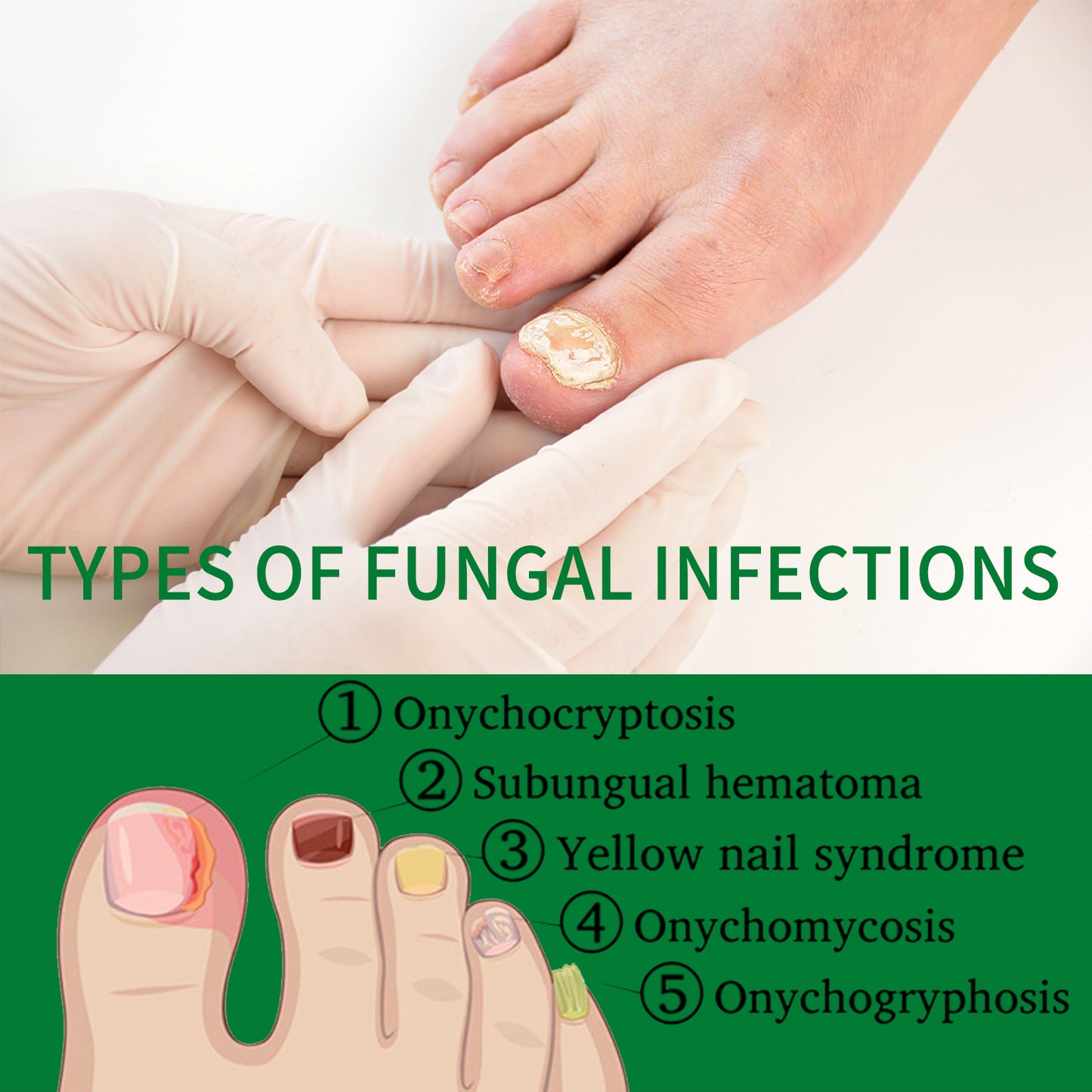 Ginger Nail Treatment