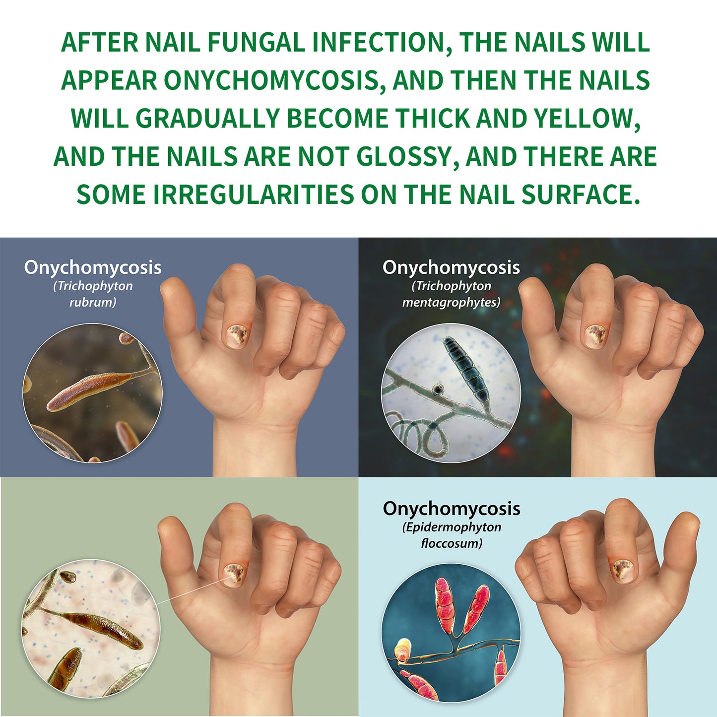 Ginger Nail Treatment