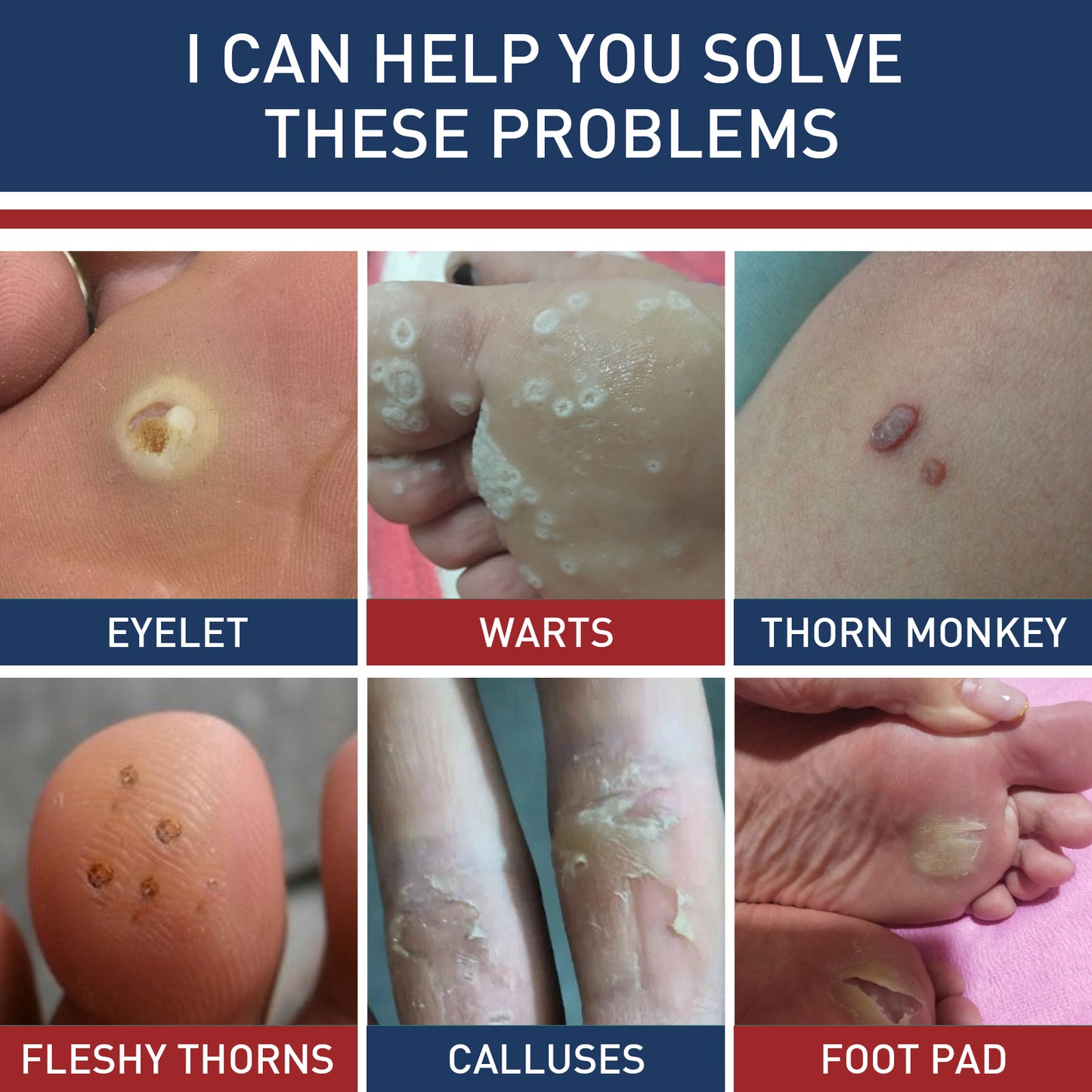 Corn Removers for Toes and Feet