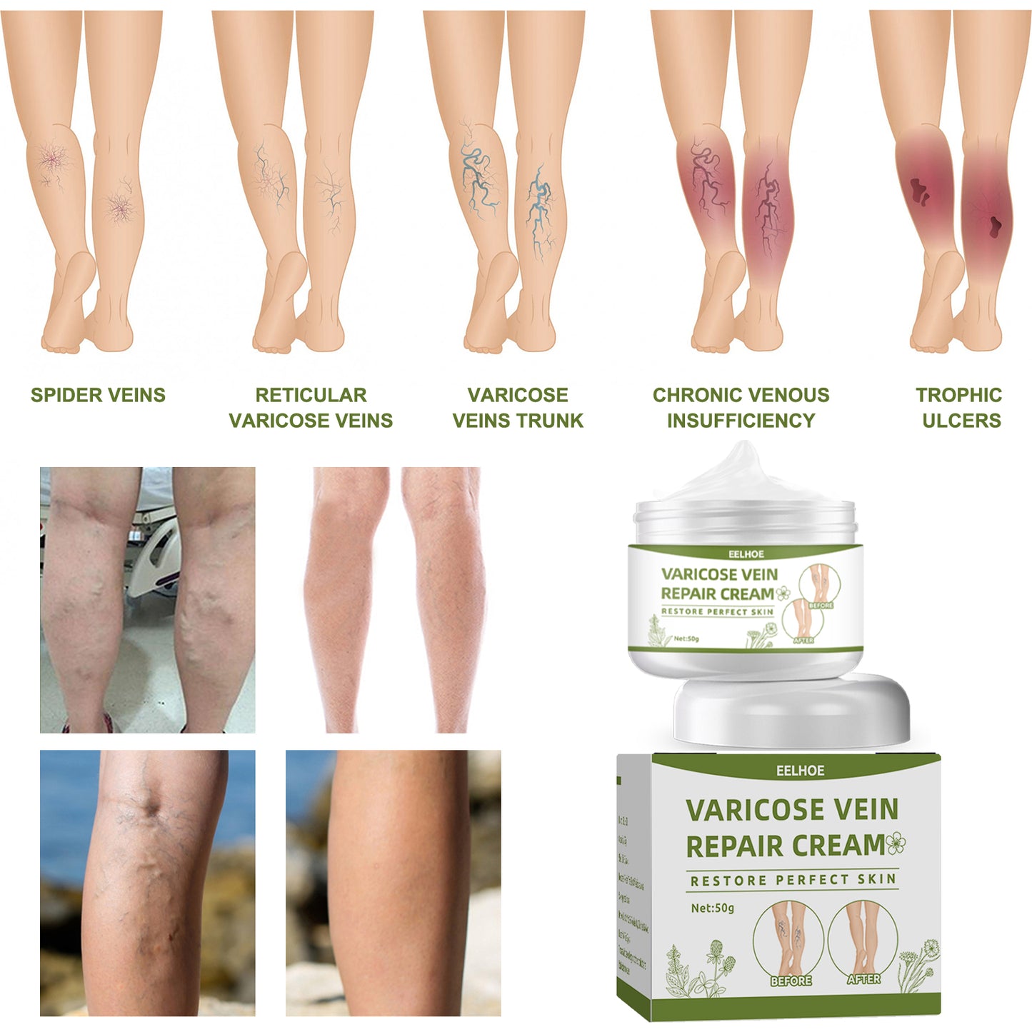 Varicose Veins Cream