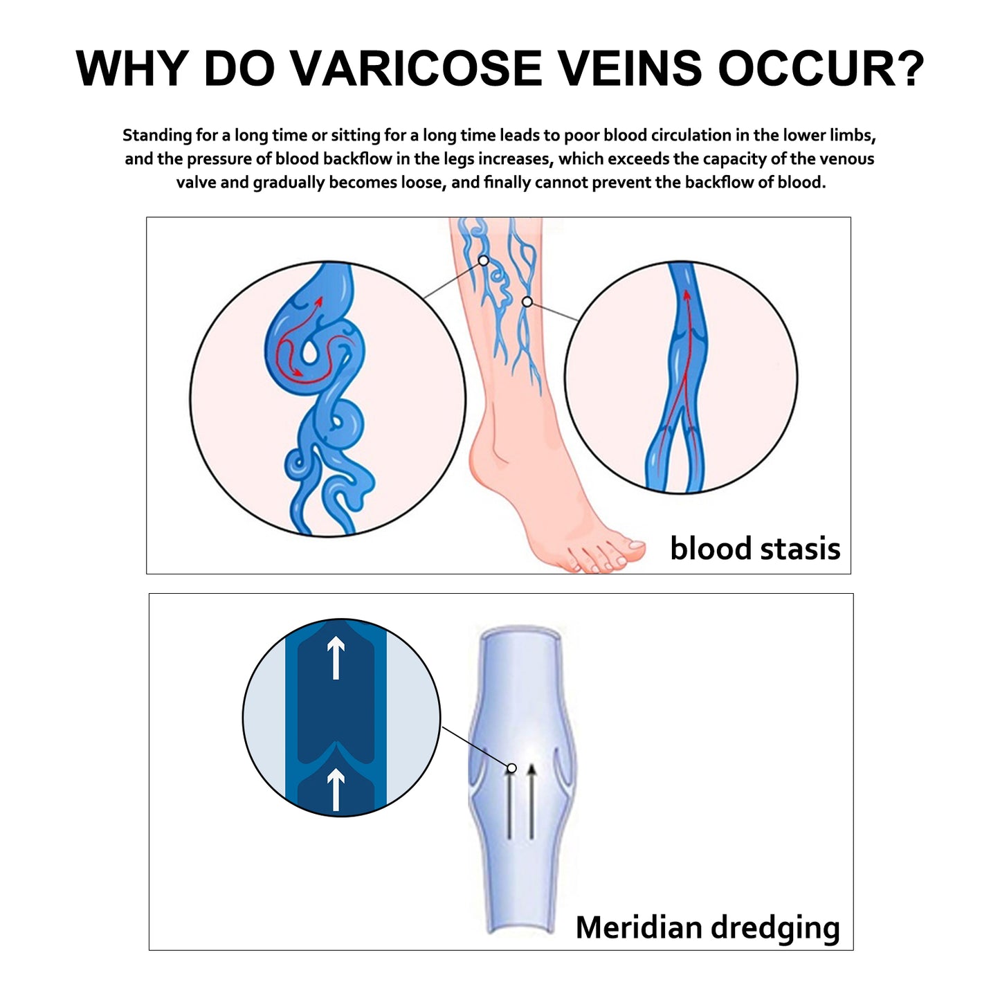 Varicose Veins Cream